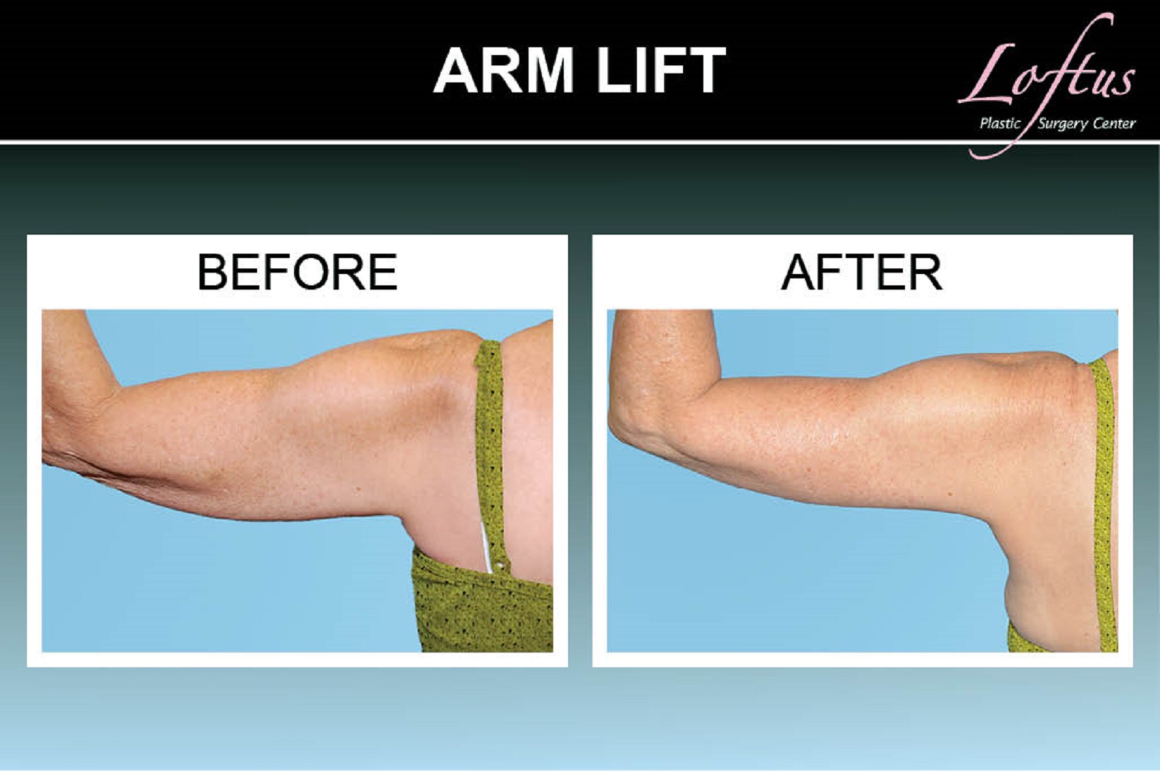 Arm Scars Before & After Photos - Arm Scars