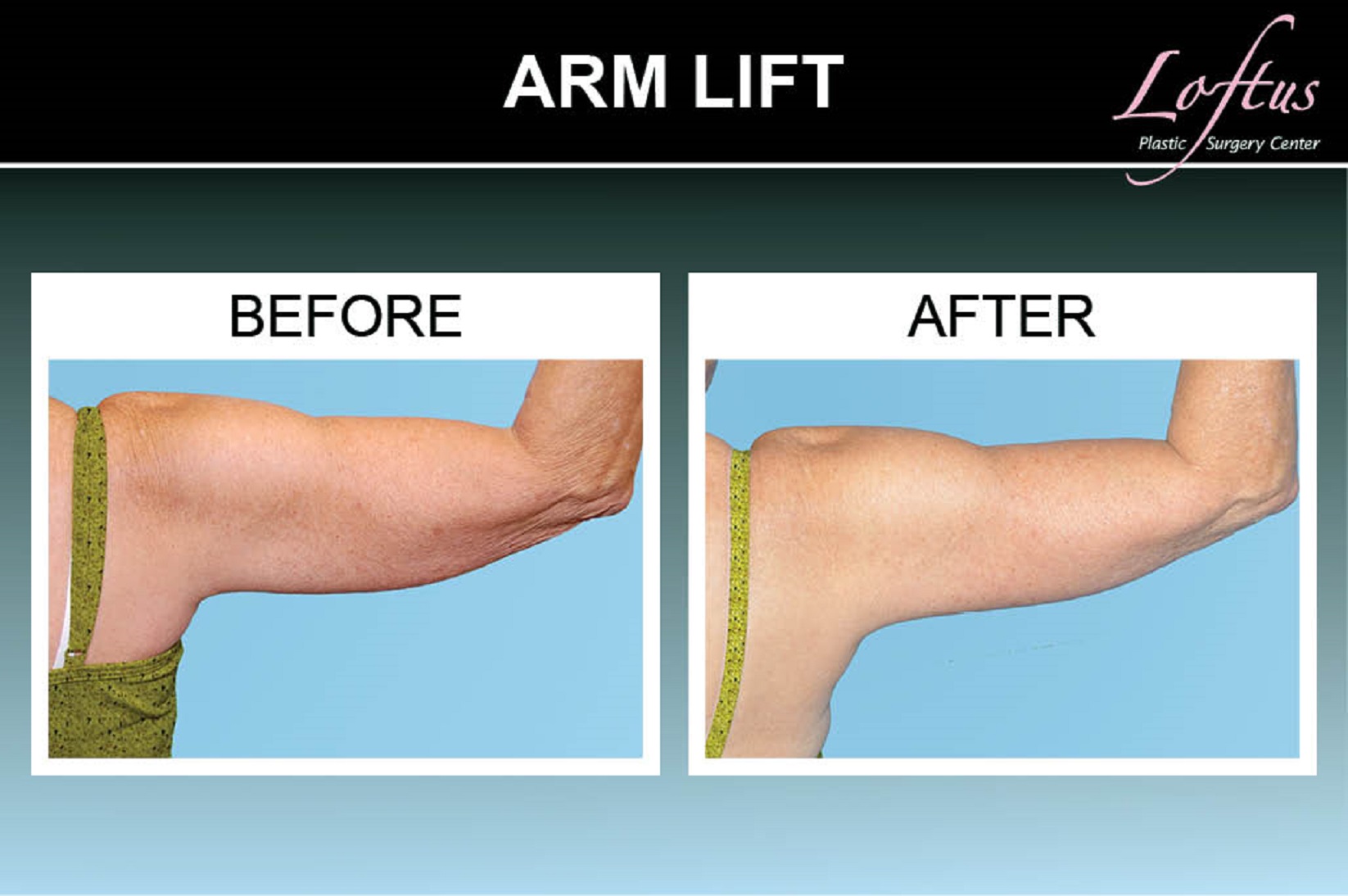 Foto de A before and after view of a successful brachioplasty procedure. An  untoned arm is seen on the left before plastic surgery, and a toned arm is  seen on the right