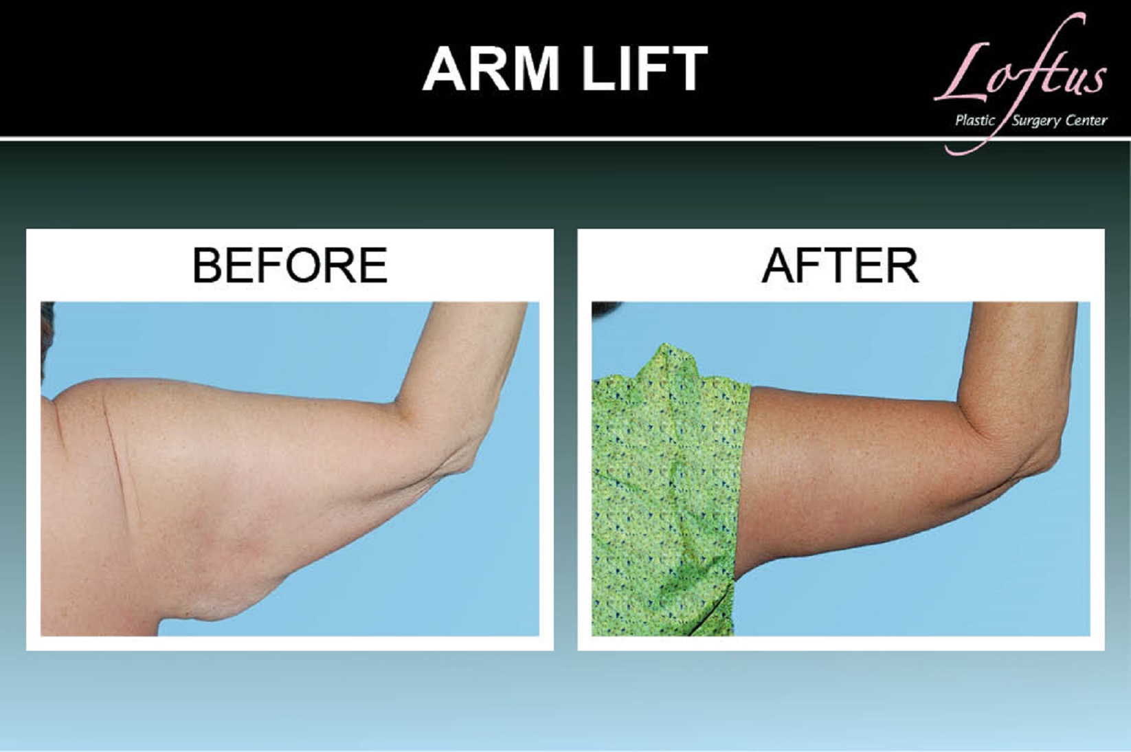 Photos, Arm Lift Before After Images