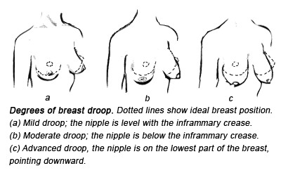 Breast Lift Expert, Types of Droop