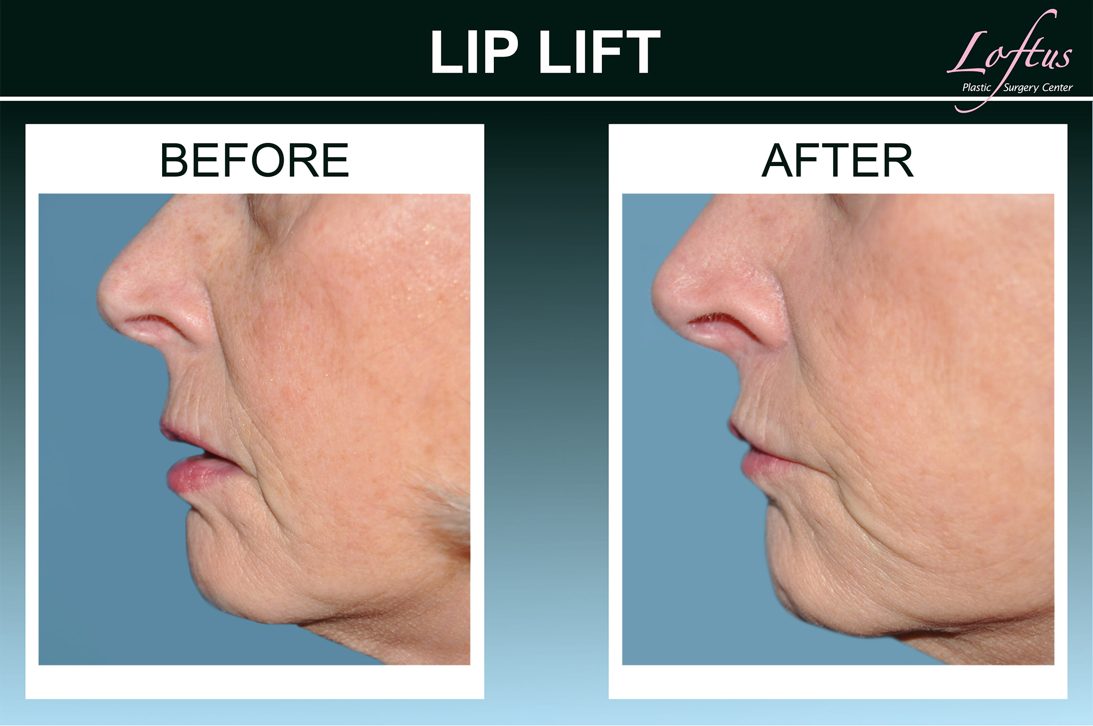 Loftus Plastic Surgery Lips