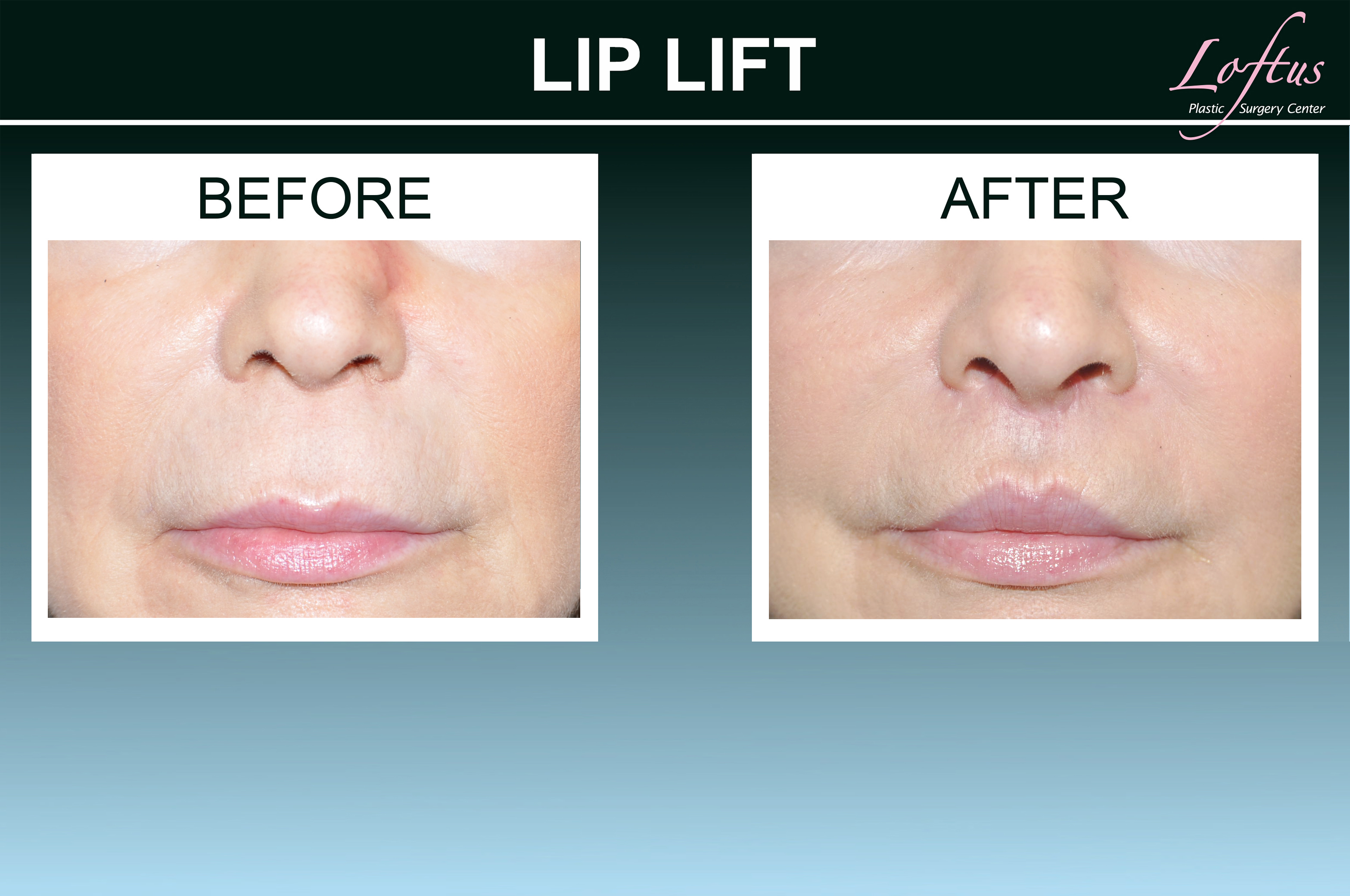 Loftus Plastic Surgery Lips
