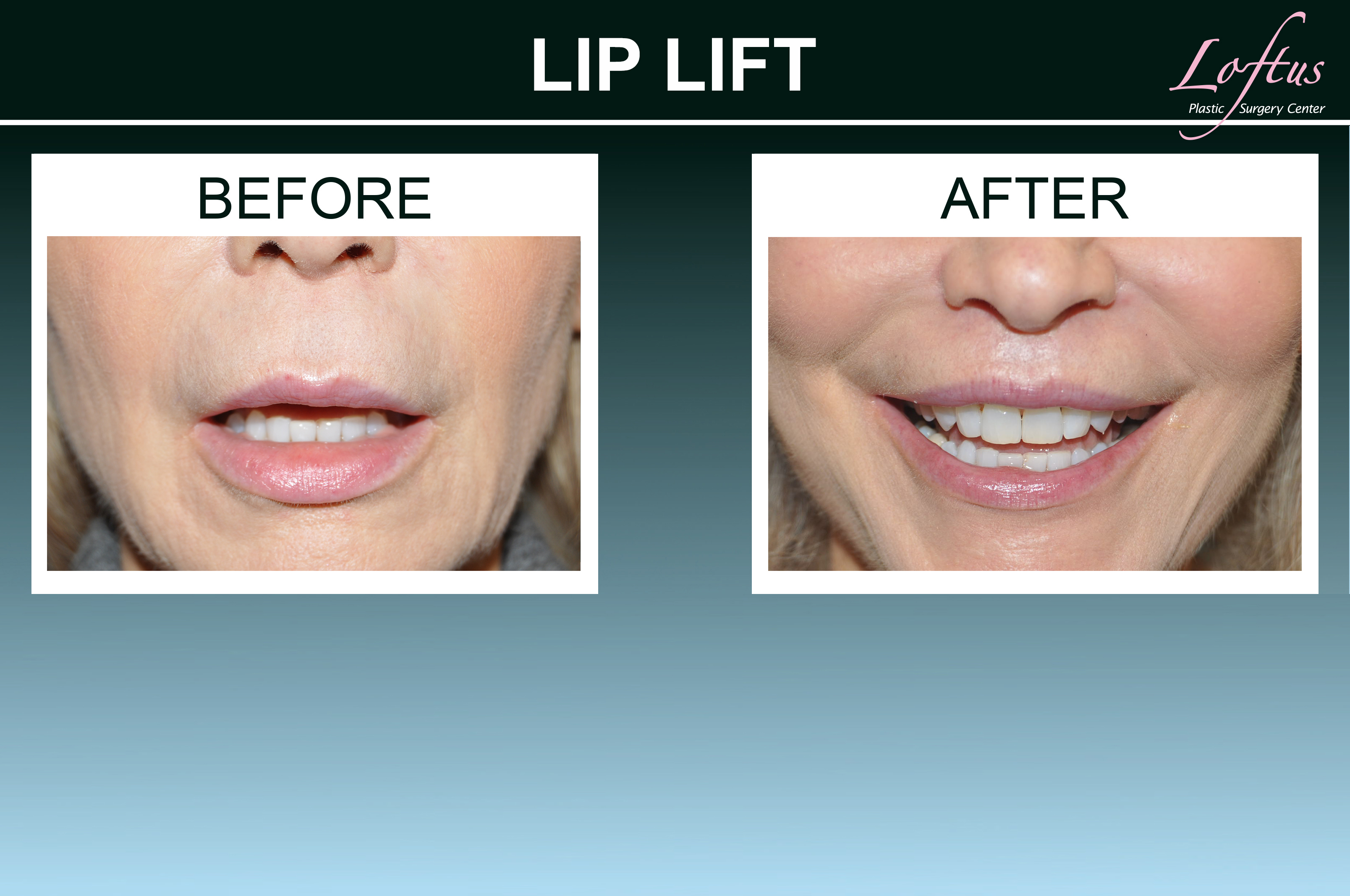 Loftus Plastic Surgery Lips