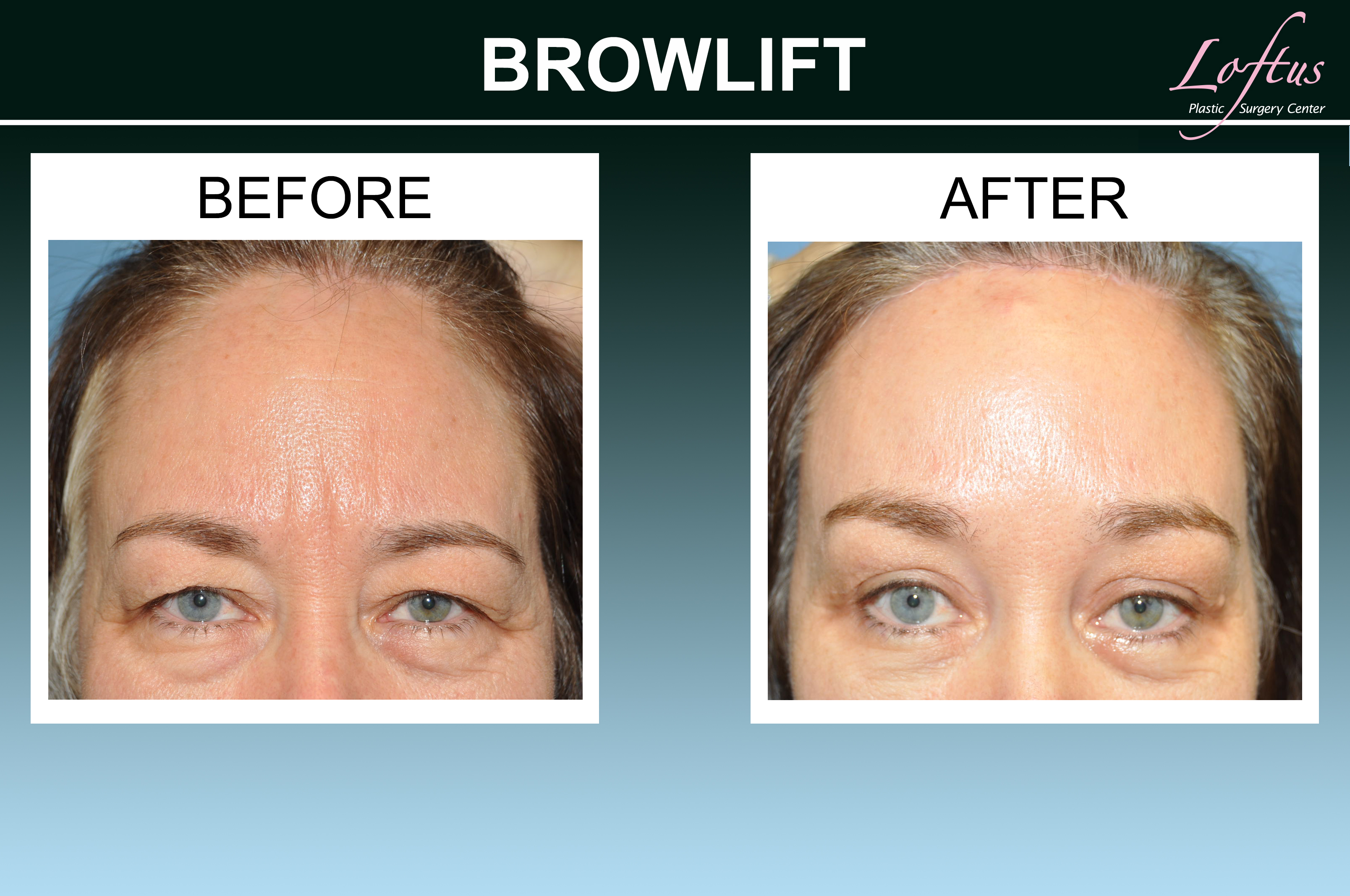 Photos Brow Lift